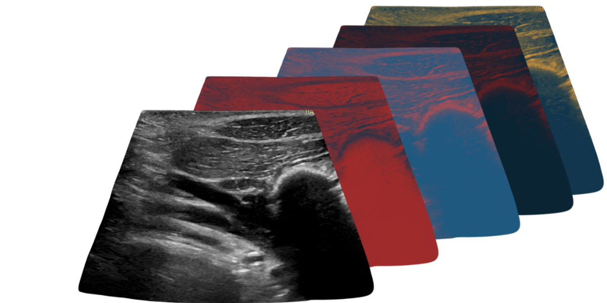 VenoSense Doppler Test
